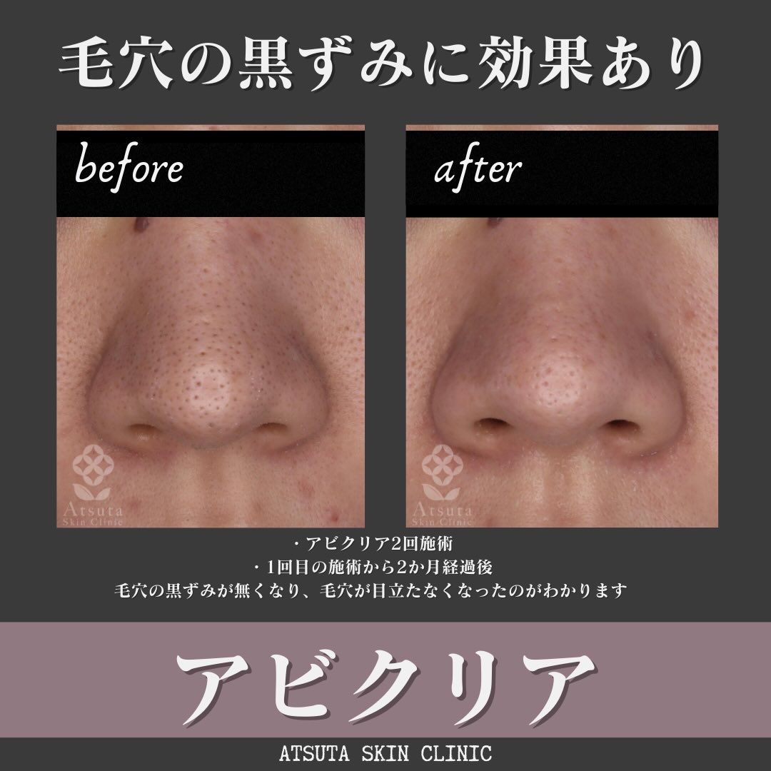 アビクリア】で鼻の毛穴が改善した症例のご紹介です。お写真使用のご承諾をいただき、ありがとうござい..|名古屋市|名古屋市民ニュース